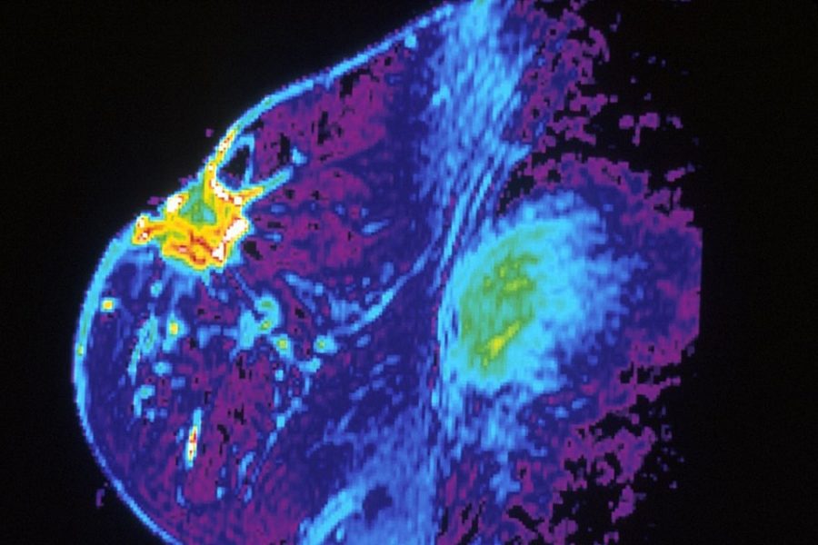 Een MRI-scan van een borst met kanker